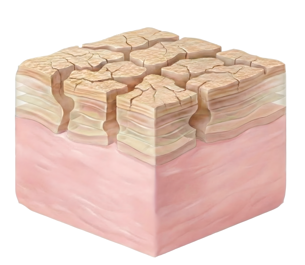 Formation des rides profondes